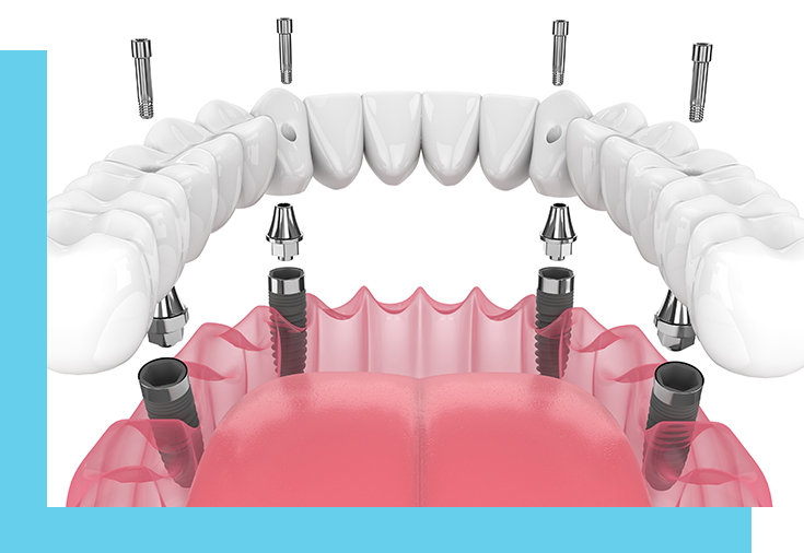 All-on-4 Dental Implants at Windsor Family Dental