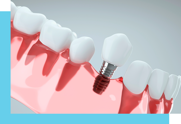 Endosteal Dental Implants from Windsor Family Dental