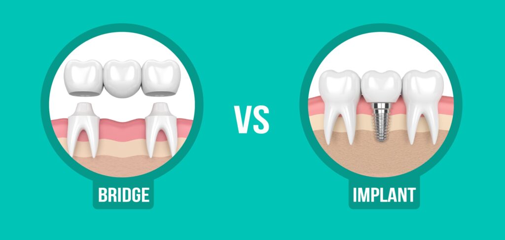 Dental bridge vs. implant