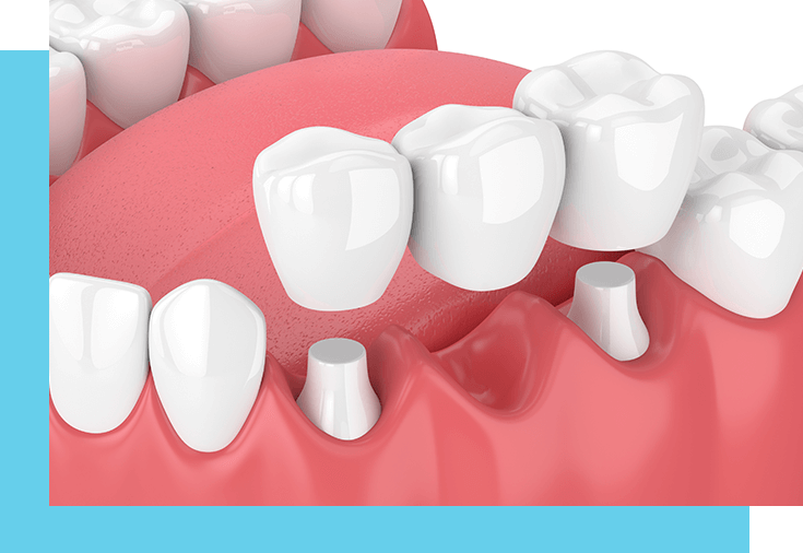 Comprehensive Guide to Dental Bridges