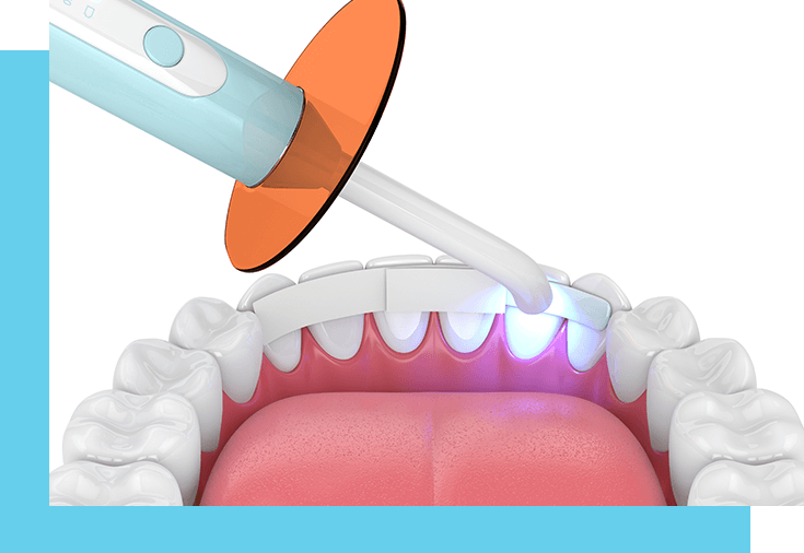 dental veneers vs. teeth bonding