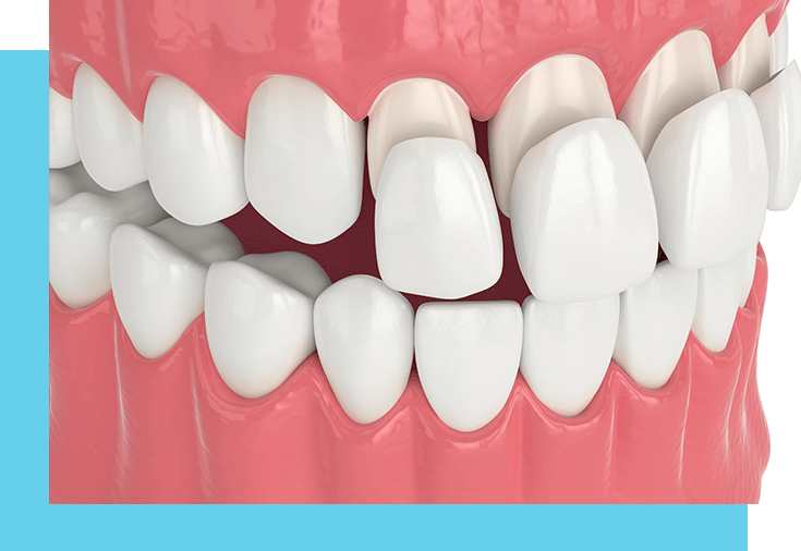 Porcelain Veneers Dentist In Sun Prairie