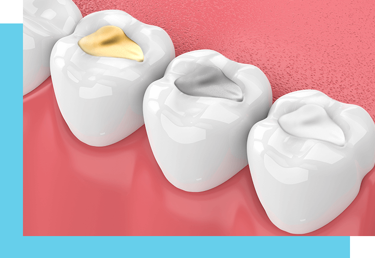 Amalgam fillings sales vs composite