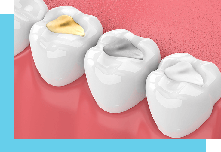 amalgam vs composite fillings