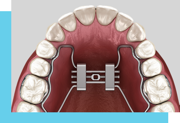 Subperiosteal Dental Implants from Windsor Family Dental