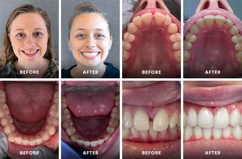 Invisalign clear aligners before and after