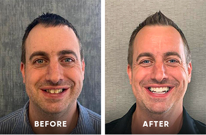 Invisalign clear aligners before and after