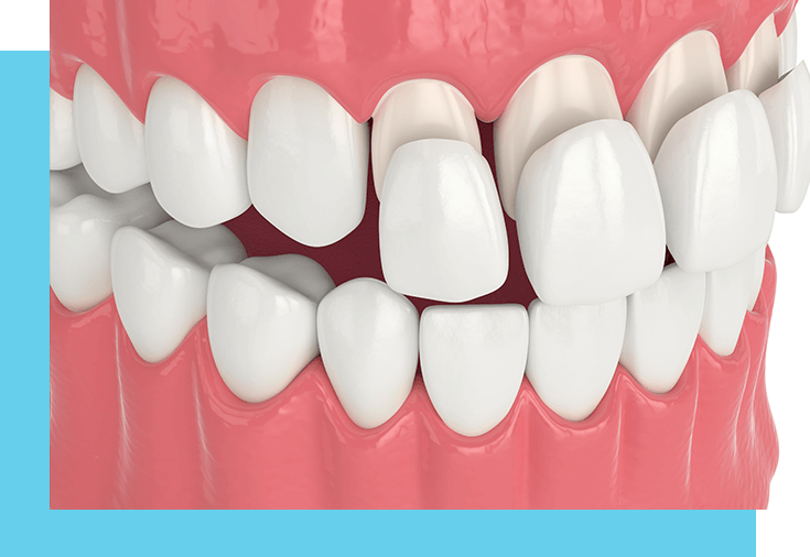 Dental bonding vs. veneers