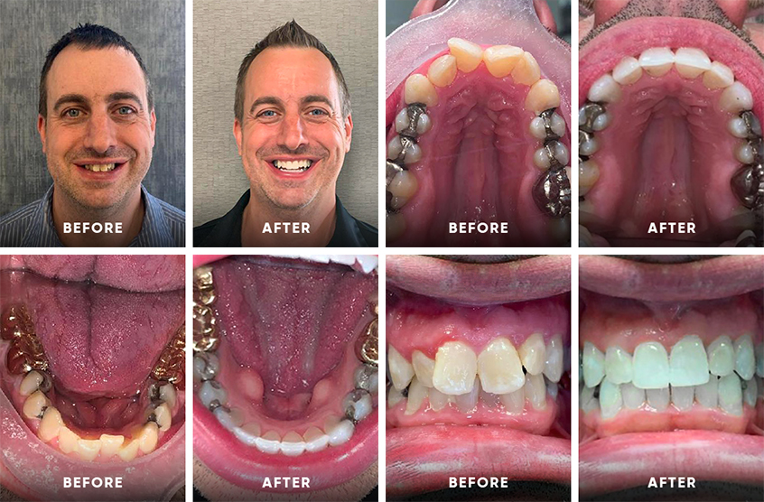 Invisalign before and after