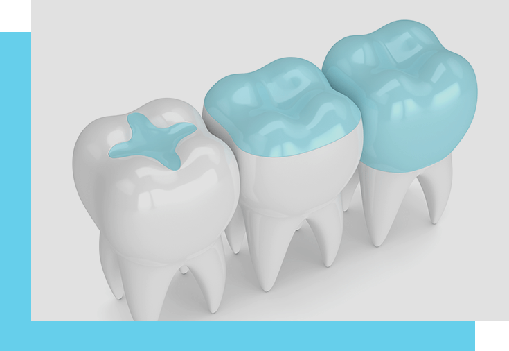 Dental sealants: tooth colored acrylics protect enamel
