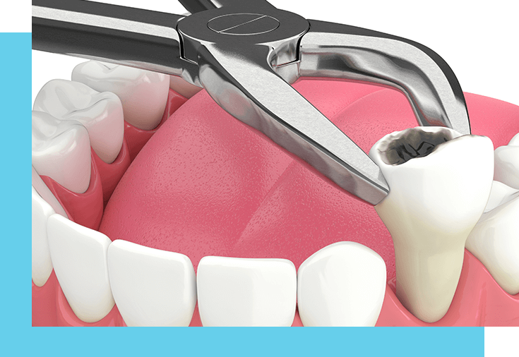 Tooth extractions for decayed or diseased teeth in Windsor, WI