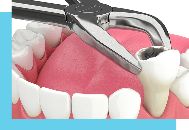 https://www.winfamdental.com/Content/images/sideImage/RES-Extraction.png